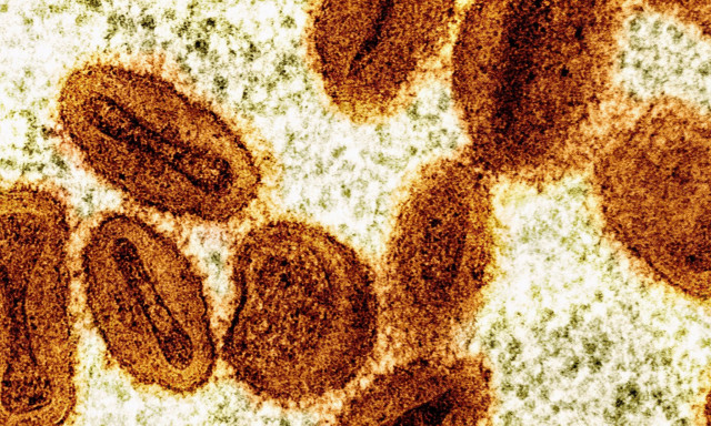 Καλιφόρνια: Εντοπίστηκε για πρώτη φορά κρούσμα της mpox χωρίς ιστορικό ταξιδιού