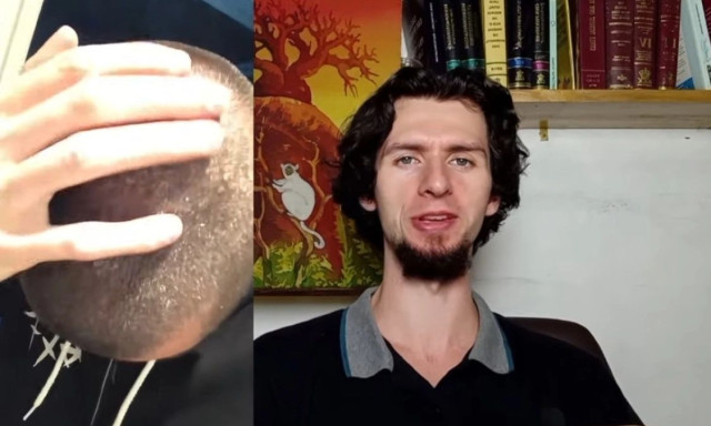 Youtuber δεν έβαζε σαμπουάν στα μαλλιά το για 8 χρόνια και έπαθε «πλάκα» με τα αποτελέσματα