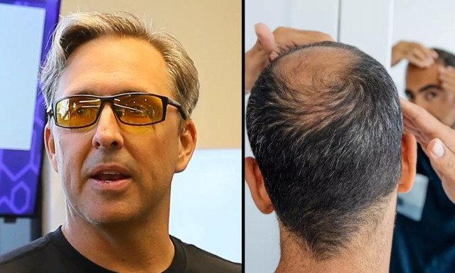 «Βιοχάκερ» αποκαλύπτει το μυστικό για να σταματήσετε την τριχόπτωση στα 20 και στα 30