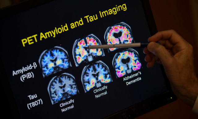Σπουδαία ανακάλυψη του Χάρβαρντ για το Αλτσχάιμερ: Είναι το λίθιο ο χαμένος κρίκος;