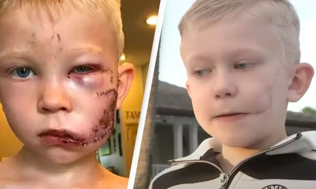 Αγοράκι έσωσε στην αδελφή του από τρομακτική επίθεση σκύλου - Του έκαναν 90 ράμματα