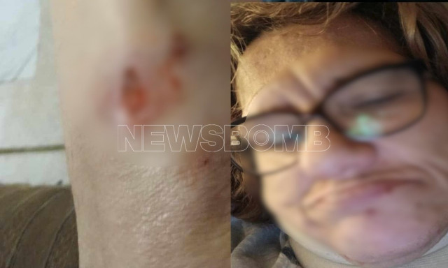 Άγιος Στέφανος: Με πληγές και σημάδια στο πρόσωπο η 58χρονη που δέχθηκε άγρια επίθεση από πιτ μπουλ