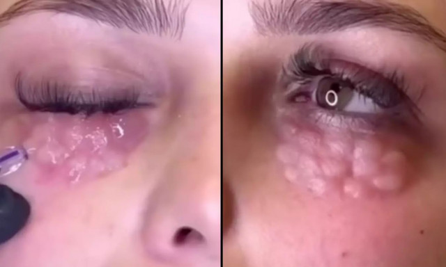 Γιατρός προειδοποιεί για επικίνδυνη νέα επέμβαση - Οι άνθρωποι μοιάζουν με «ερπετά»