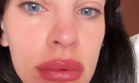 Χριστίνα Μπόμπα: «Ξύπνησα έτσι - Τα χείλη μου έγιναν τριπλάσια»