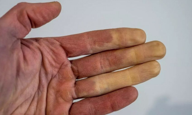 Αλλάζουν χρώμα τα δάχτυλα σας τον χειμώνα; Η ασθένεια που κρύβεται από πίσω