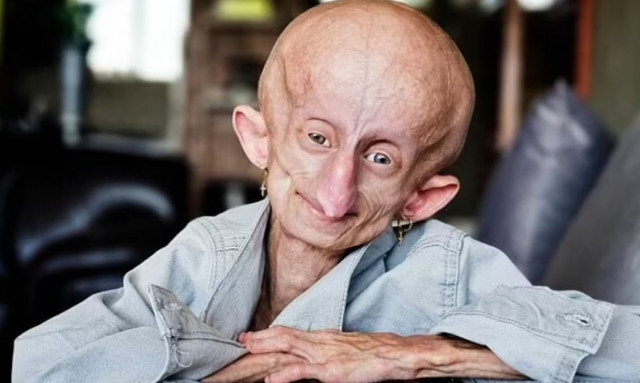 Beandri Booysen: Πέθανε στα 19 το γενναίο κορίτσι που γερνούσε κατά 8 χρόνια σε 12 μήνες