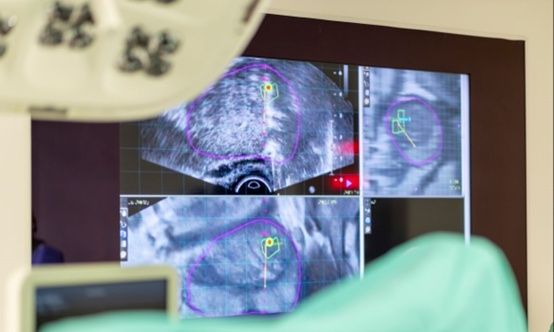 FUSION Βιοψία: Μία νέα εποχή στη διάγνωση του καρκίνου του προστάτη