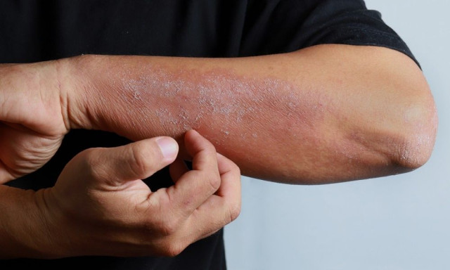 Γιατί «φουντώνει» η ψωρίαση στις γιορτές