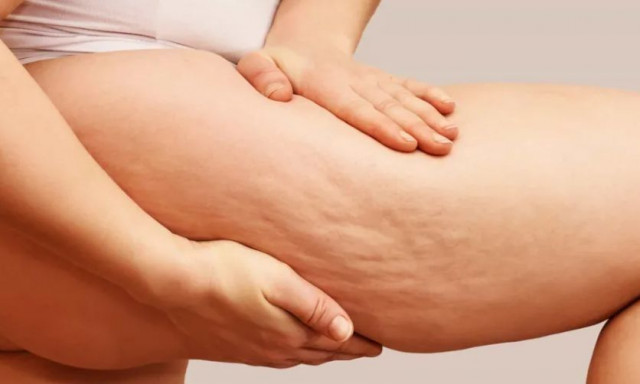 Δύο προϊόντα που μπορούν να βοηθήσουν στην καταπολέμηση της κυτταρίτιδας