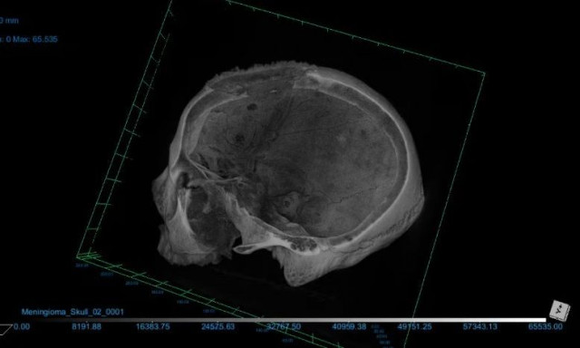 Οι αρχαιολόγοι διαπίστωσαν ότι οι αρχαίοι Αιγύπτιοι προσπαθούσαν να θεραπεύσουν τον καρκίνο