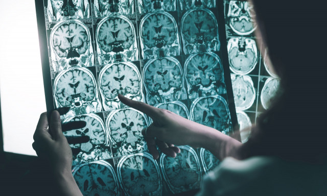 Επιστημονική μελέτη: Ο ανθρώπινος εγκέφαλος περιέχει μια ολόκληρη κουταλιά μικροπλαστικών