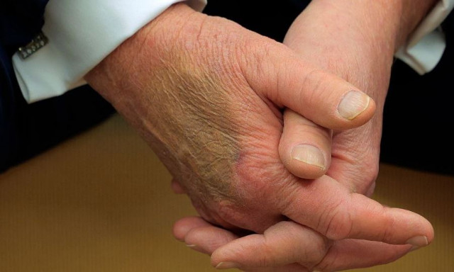 Ντόναλντ Τραμπ: Ανησυχία για την τεράστια μελανιά στο χέρι του - Η εξήγηση του Λευκού Οίκου