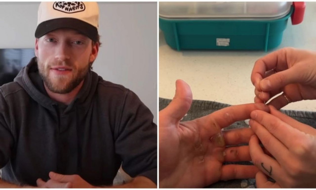 Έσπασε το ρεκόρ Guiness έλξεων σε μία μέρα: Οι ανατριχιαστικές συνέπειες που είχαν τα χέρια του