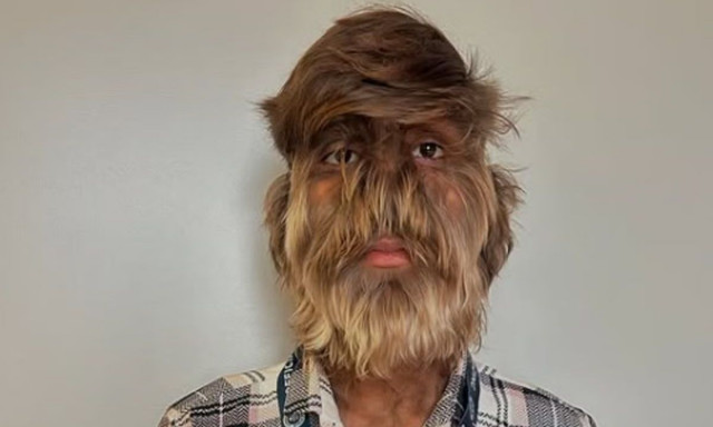 Ινδία: 18χρονος κέρδισε το ρεκόρ Γκίνες για το πιο τριχωτό πρόσωπο στον κόσμο