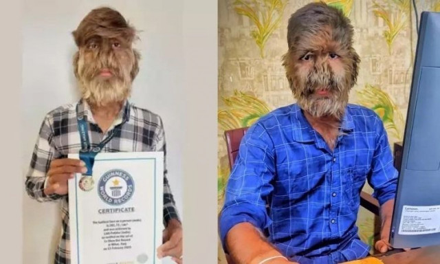 Ο έφηβος με το «σύνδρομο λυκανθρώπου» που μπήκε στο Γκίνες