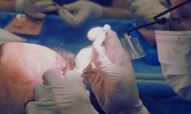 Μεταμόσχευση μαλλιών: Ποια είναι η καλύτερη τεχνική;