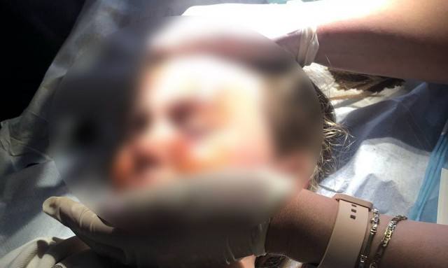 Αγρίνιο: Άγρια επίθεση σκύλου σε κοριτσάκι 4,5 ετών - Τη δάγκωσε στο πρόσωπο