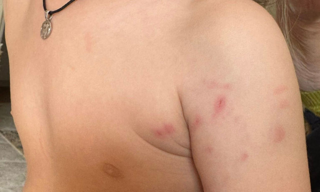 Αιτωλικό: Αδέσποτος σκύλος επιτέθηκε σε ανήλικο - Με σοβαρά τραύματα στο νοσοκομείο