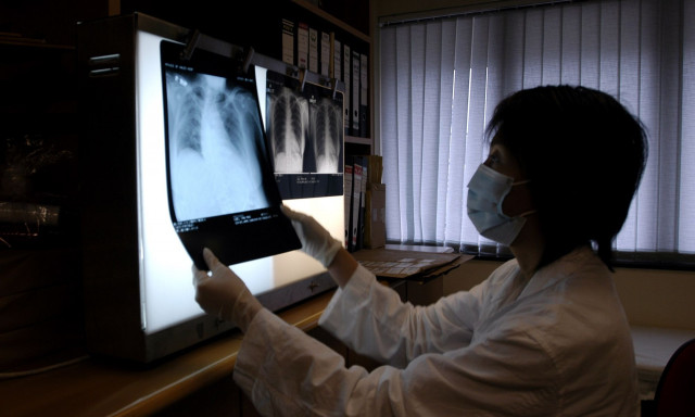 Πνευμονική υπέρταση: Γιατί συχνά οι ασθενείς έχουν λανθασμένη διάγνωση-Τα συμπτώματα που μπερδεύουν