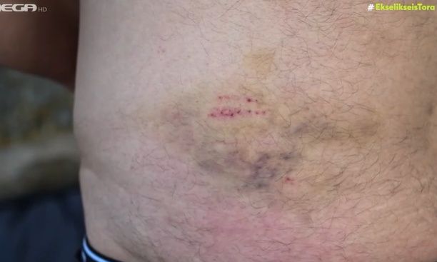 Μύκονος: Η μαρτυρία του 45χρονου που κατήγγειλε άγριο ξυλοδαρμό από αστυνομικούς - Διαψεύδει η ΕΛΑΣ