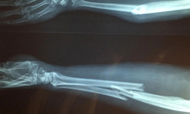 H περίεργη θεωρία για ανθρώπους που «δεν έχουν σπάσει ποτέ κόκαλο»