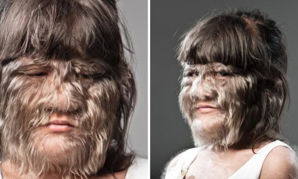 Πώς είναι σήμερα το πιο τριχωτό κορίτσι του κόσμου - Παντρεύτηκε και ξύρισε το πρόσωπο της