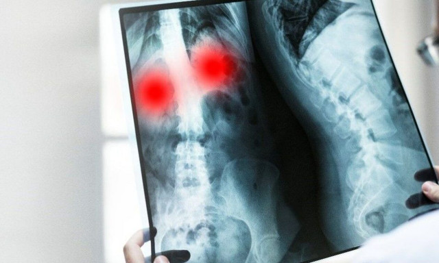 Προσοχή: Ένα απροσδόκητο σύμπτωμα μπορεί να σας προειδοποιήσει για καρκίνο του πνεύμονα