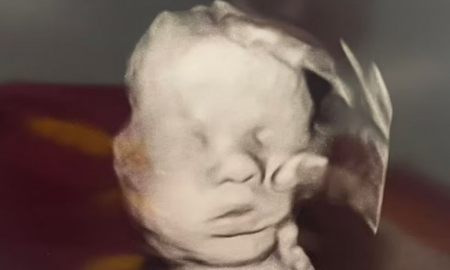 Το «Χέρι του Θεού» στο υπερηχογράφημα - Η μυστηριώδης σκιά που χαϊδεύει το κεφάλι του μωρού