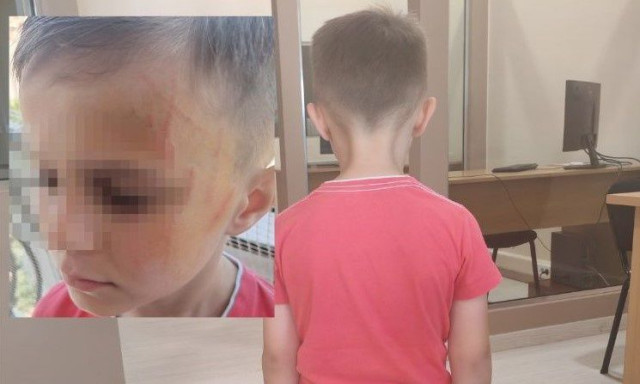 Εφιάλτης για 5χρονο στο Αγρίνιο: Τον έδειραν συμμαθητές του στο νηπιαγωγείο