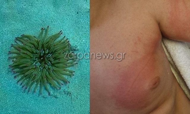 Χανιά: Πανικός στο Μαράθι – Πέντε περιστατικά τσιμπήματος από θαλάσσια ανεμώνη