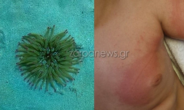 Χανιά: Αυξάνονται τα περιστατικά τσιμπημάτων από θαλάσσια ανεμώνη