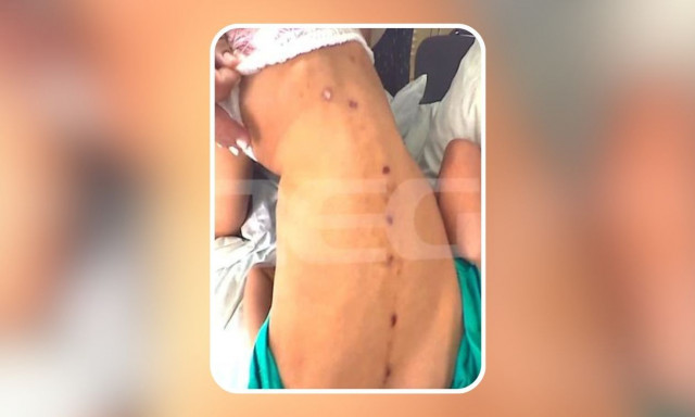 Πάτρα: Μυστήριο με τα σημάδια στο 10χρονο παιδί - Για κακοποίηση μιλά ο γιατρός που το εξέτασε