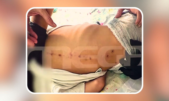 Πάτρα: Νέες μαρτυρίες για τα σημάδια στην πλάτη του 10χρονου - Κακοποίηση υποστηρίζει η βιβλιογραφία