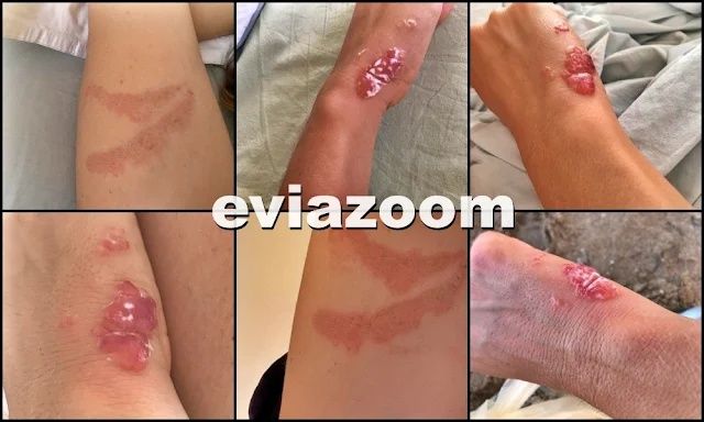 Χαλκίδα: Εφιάλτης για δύο λουόμενες, βγήκαν από τη θάλασσα με πληγές και σημάδια – Δείτε εικόνες