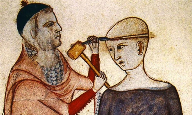 Αρχαία ιατρική: Η σοκαριστική θεραπεία για τον πονοκέφαλο ήταν… τρύπα στο κρανίο