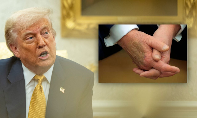 Tραμπ: Οργιάζουν οι φήμες για την υγεία του μετά τις μυστηριώδεις μελανιές στα χέρια του