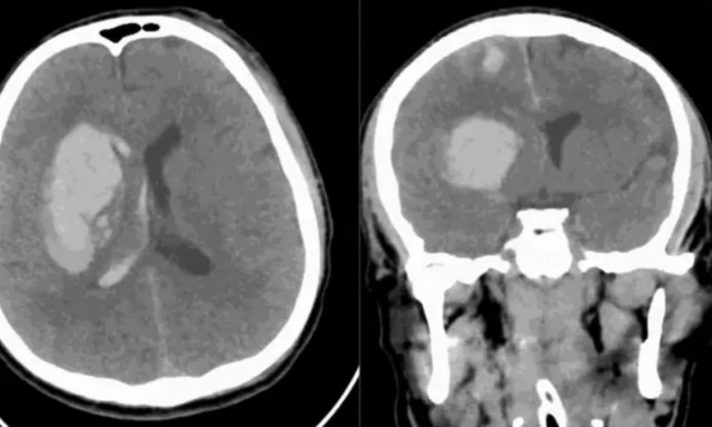 «Αόρατος δολοφόνος»: Ο μύκητας που απειλεί τον εγκέφαλο και αντιστέκεται στα φάρμακα