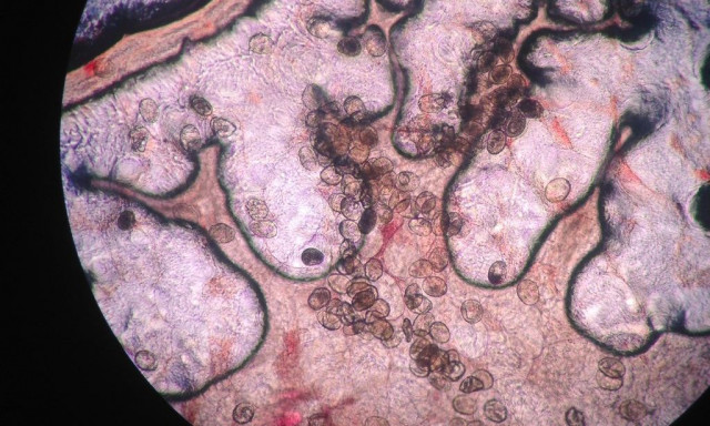 Τρόμος από παρασιτικό σκουλήκι: Προκαλεί καρκίνο και εισβάλλει στο σώμα... χωρίς να το καταλάβεις