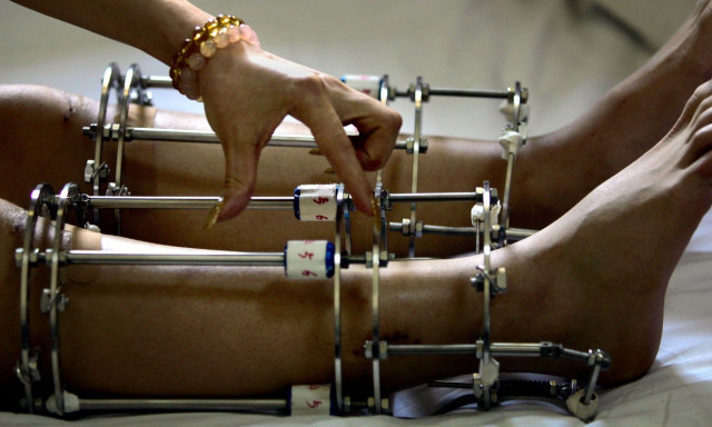 Άνδρες πληρώνουν χιλιάδες δολάρια για να τους σπάνε τα πόδια με σκοπό να γίνουν ψηλότεροι