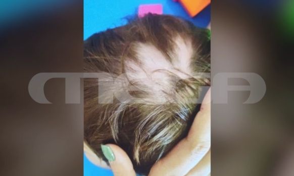 Ωρωπός: Φωτογραφία ντοκουμέντο από το 2χρονο αγοράκι που του ξερίζωσαν τα μαλλιά στον βρεφονηπιακό