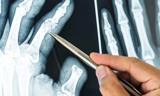 Σούπερ κόλλα για τα οστά μπορεί να διορθώσει κατάγματα σε λίγα λεπτά