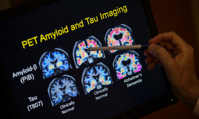 Υπάρχει ένα κρίσιμο πράγμα που μπορείτε να κάνετε για να κρατήσετε υπό έλεγχο συμπτώματα Αλτσχάιμερ