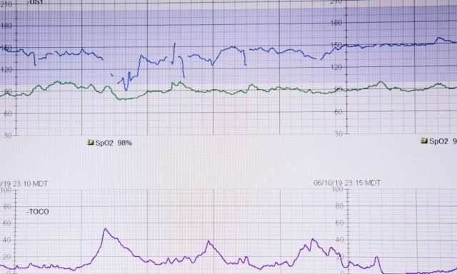 Απίστευτο ιατρικό περιστατικό: Άνδρας έφτασε τους 600 παλμούς το λεπτό