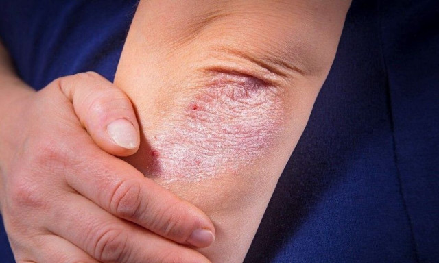 Ψωρίαση: Εκτοξεύονται τα περιστατικά παγκοσμίως, ειδικά σε εύπορες περιοχές