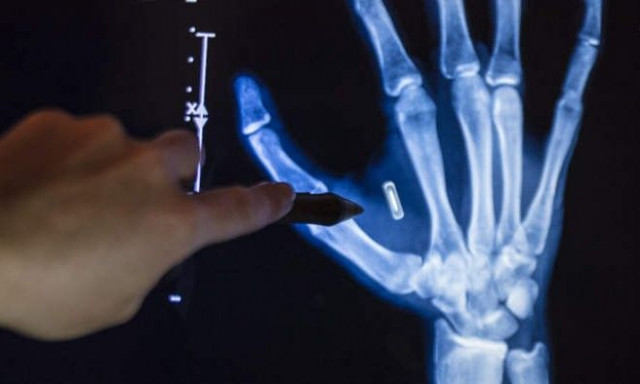 Μιζούρι: Εμφύτευσε τσιπ στο χέρι του και ξέχασε τον κωδικό