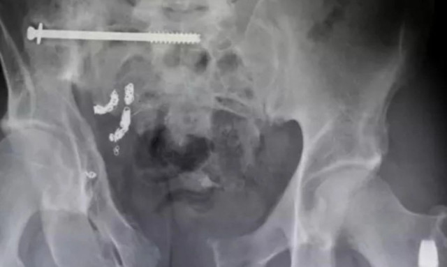 Η κυβέρνηση των ΗΠΑ αποκάλυψε τα 25 χειρότερα πράγματα που κόλλησαν σε οπίσθια ανθρώπων το 2025