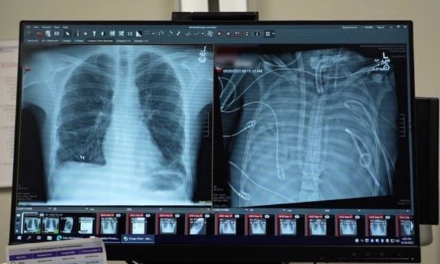 ΗΠΑ: Τον κράτησαν ζωντανό χωρίς πνεύμονες έως ότου βρεθεί μόσχευμα - Το πρωτοποριακό σύστημα