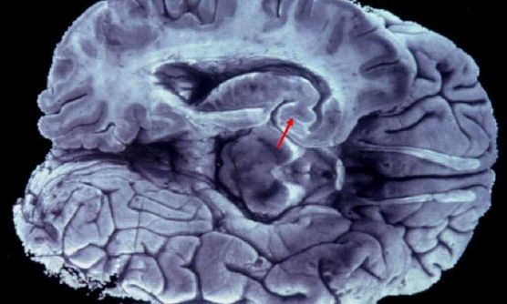 Μελετούν τον εγκέφαλο και ανακαλύπτουν τυχαία μυστηριώδεις δομές: «Αντιπροσωπεύουν ένα νέο πρότυπο»