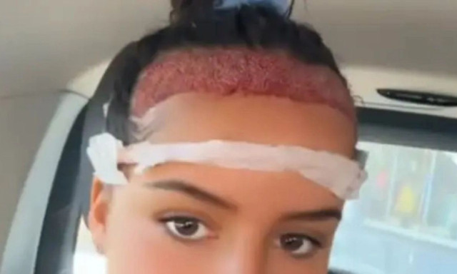 16χρονη ταξίδεψε στην Τουρκία για να βάλει μαλλιά: Το αποτέλεσμα μετά από έναν χρόνο έγινε viral