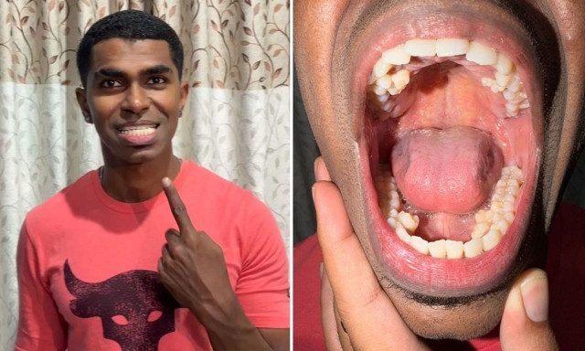Ο άνθρωπος με τα περισσότερα δόντια στον κόσμο – Πόσα είναι και τι πάθηση έχει